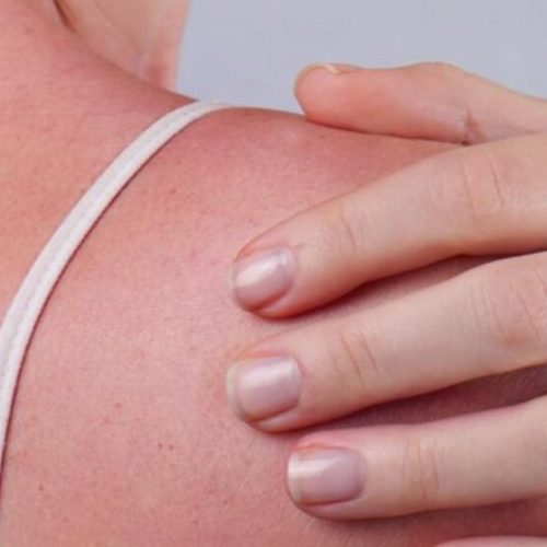 Zonschade & UV schade behandelen met lasers bij Het Laserkabinet in Herentals