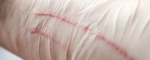 Littekens verwijderen met laserbehandeling bij het Laserkabinet in Herentals