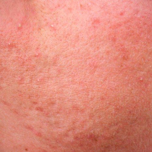 Het Laserkabinet: Rosacea behandelen met lasertherapie en medisch product advies.