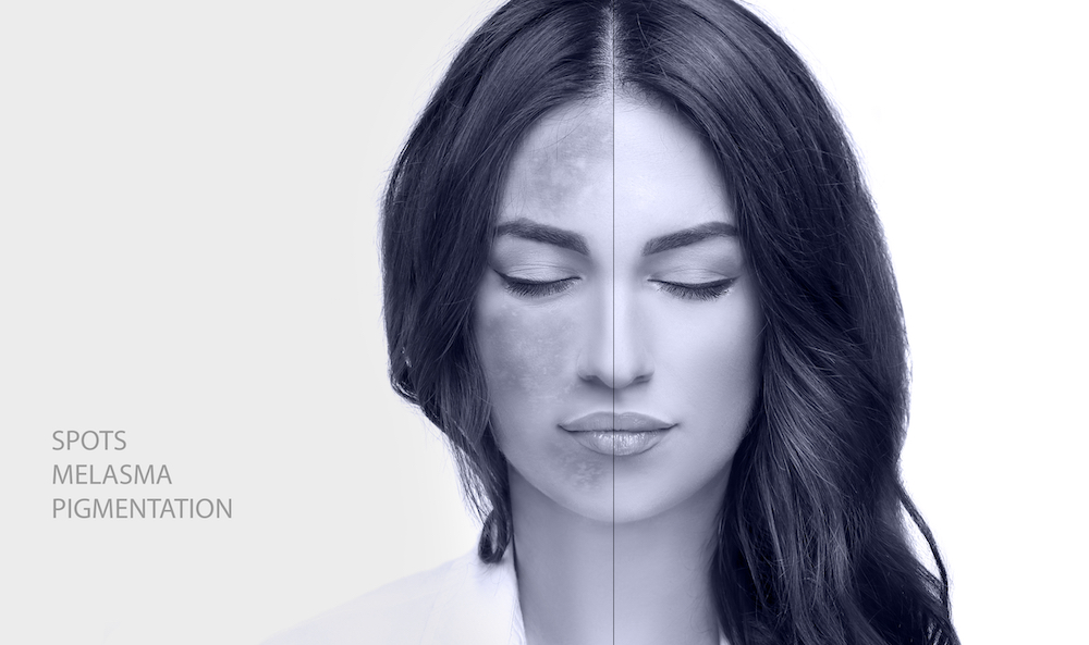 Huidanalyse bij het Laserkabinet in Herentals