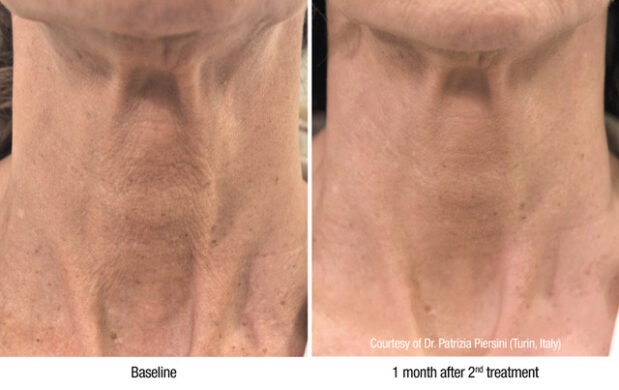 Profhilo anti-aging behandeling bij het Laserkabinet in Herentals